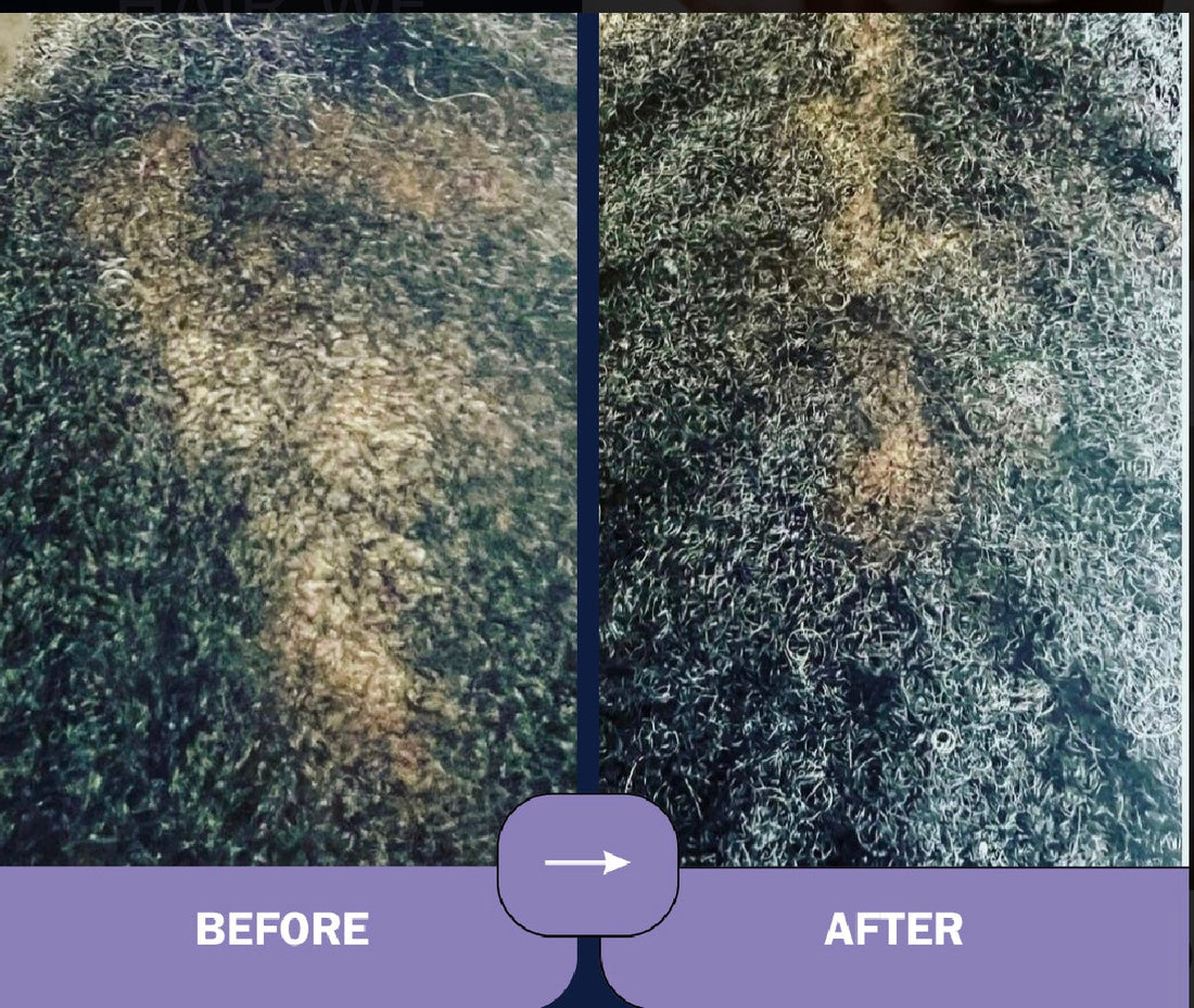 Improper diet & Hair loss